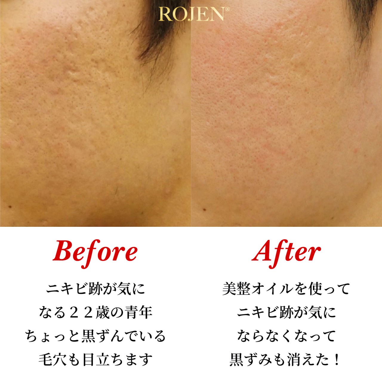 今回は
え❓️こんなに変わるの⁉️
と思うほど変わった22歳男子の
ビフォーアフターをご紹介😍
✨️✨️✨️✨️✨️✨️✨️
ニキビ跡だけじゃなく
黒ずんでいた毛穴も
美整オイルで目立たなくなってる‼️
✨️✨️✨️✨️✨️✨️✨️
その他にもたくさんの
美整オイルエンジェルの
劇的なビフォアフター
ぜひこちらからご覧ください❣️
https://rojen.jp/category/before-and-after/
✨✨✨ 💖 ✨✨✨
ROJEN® BISEIOIL®
美しさを磨き上げる
“お肌が食べる塗るサプリ”
美整オイル®
https://rojen.jp/bisei-oil/
🇺🇲アメリカでのご購入はこちらから
https://biseioil.com/
#ROJEN #biseioil #ロジェン #美整オイル #魔法の5秒リフト #塗るサプリメント #アンチエイジング #美肌 #美脚 #オーガニック #スキンケア #美容オイル #セルフケア #紫外線対策 #紫外線ケア #シミ対策 #シワ対策 #スキンケアアイテム #乾燥肌ケア #乾燥肌対策