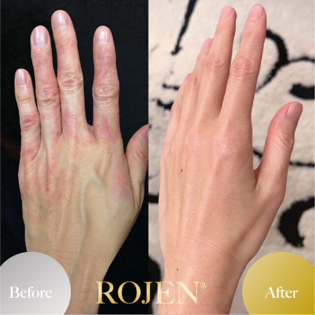 美整オイル🌹
ビフォーアフター特集⭐️

美整オイルをただ塗ってるだけ。
ホントにただ塗ってるだけで、
こんなに変わっちゃった
喜びの声特集です❣️

https://rojen.jp/category/before-and-after/

✨✨✨ 💖 ✨✨✨
🇯🇵日本
ROJEN公式サイト
rojen.jp
スキンケアご購入ダイレクトページ
https://rojen.jp/bisei-oil/shop/
メルマガ登録でいち早くお知らせGET❣️
https://rojen.jp/mailmagazine/
公式LINE登録で特別メッセージをGET❣️
https://lin.ee/EdDlMnt
インスタフォロー＆Facebookフォロー
https://www.instagram.com/rojenofficial/
https://www.facebook.com/rojen.biseioil/
✨✨✨ 💖 ✨✨✨
🇺🇸USA
ROJEN Official
rojenusa.com
ROJEN Organic Skincare 
https://rojenusa.com/biseioil/
Subscribe by Email:
https://rojenusa.com/newsletter/
Follow on Instagram:
https://www.instagram.com/rojenofficial/
✨ You’ll receive exclusive discounts and
 special offers with every newsletter!
#ROJEN #ロジェン #biseioil #美整オイル #魔法の5秒リフト #塗るサプリメント #ビフォーアフター #弾力ある肌に変身 #ほうれい線 #目元のたるみ #シミ対策 #シワ対策 #乾燥肌ケア #乾燥肌対策 #毛穴の黒ずみ #肌のシミ