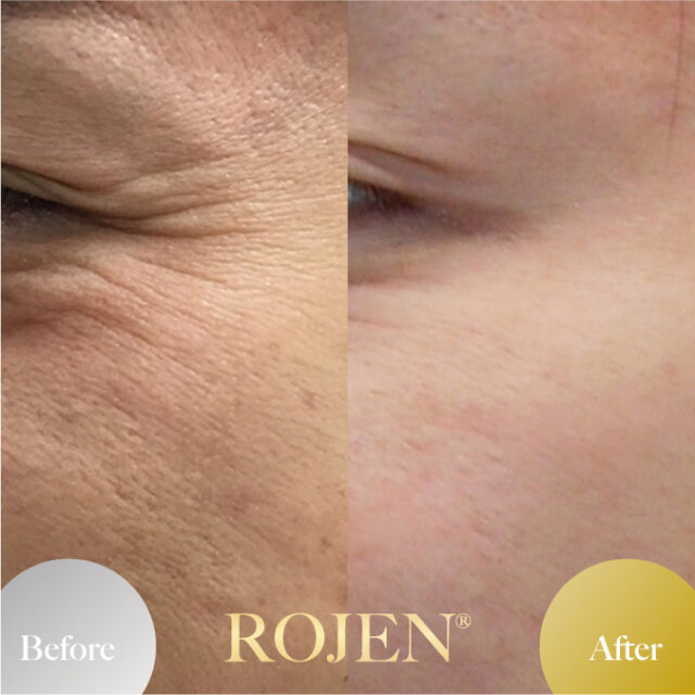 美整オイル🌹
ビフォーアフター特集⭐️

美整オイルをただ塗ってるだけで、
肌がこんなに変わっちゃった🥰
https://rojen.jp/category/before-and-after/

✨✨✨ 💖 ✨✨✨
🇯🇵日本
ROJEN公式サイト
rojen.jp
スキンケアご購入ダイレクトページ
https://rojen.jp/bisei-oil/shop/
メルマガ登録でいち早くお知らせGET❣️
https://rojen.jp/mailmagazine/
公式LINE登録で特別メッセージをGET❣️
https://lin.ee/EdDlMnt
インスタフォロー＆Facebookフォロー
https://www.instagram.com/rojenofficial/
https://www.facebook.com/rojen.biseioil/
✨✨✨ 💖 ✨✨✨
🇺🇸USA
ROJEN Official
rojenusa.com
ROJEN Organic Skincare 
https://rojenusa.com/biseioil/
Subscribe by Email:
https://rojenusa.com/newsletter/
Follow on Instagram:
https://www.instagram.com/rojenofficial/
✨ You’ll receive exclusive discounts and
 special offers with every newsletter!

#ROJEN #ロジェン #biseioil #美整オイル #魔法の5秒リフト #塗るサプリメント #ビフォーアフター #弾力ある肌に変身 #ほうれい線 #目元のたるみ #シミ対策 #シワ対策 #乾燥肌ケア #乾燥肌対策 #毛穴の黒ずみ #肌のシミ