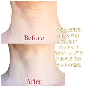 美整®ローズオットーで首筋もこんなに若返った！！
