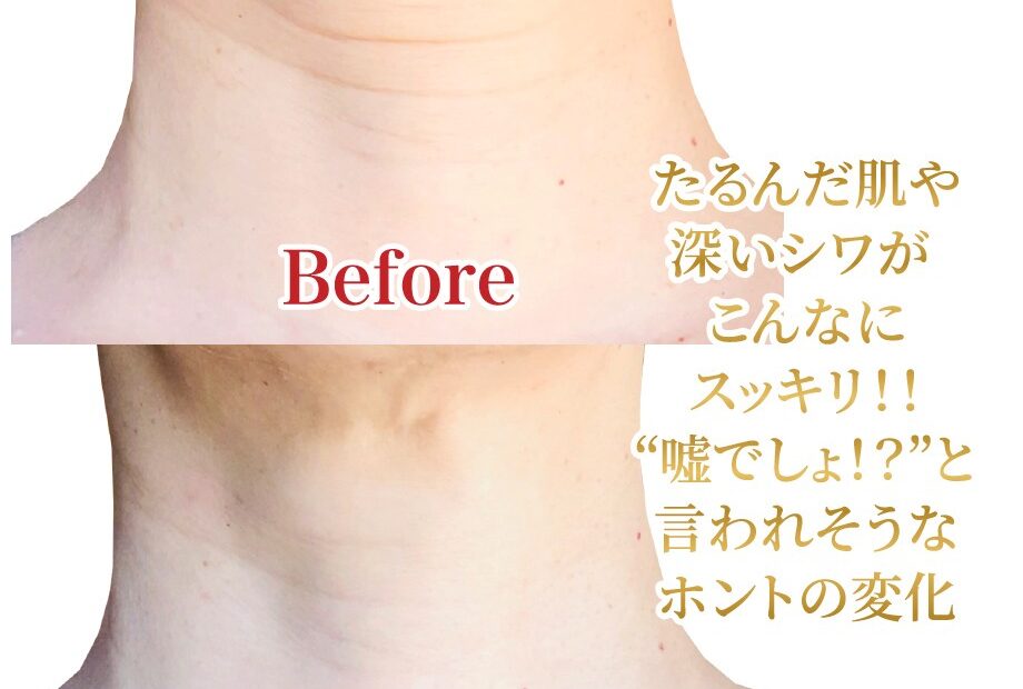 美整®ローズオットーで首筋もこんなに若返った！！