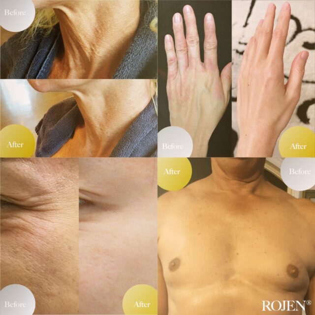 まさに魔法のパワー？！
💖信じられないB＆Aが話題💖
✨️✨️✨️✨️✨️✨️✨️
美の救世主ROJEN美整オイル
細胞の若返り＆筋肉の栄養素
オメガ＆抗酸化物質パワー
✨️✨️✨️✨️✨️✨️✨️

🤩

男性は本当に分かりやすい！
二重顎もアップ！
肩も背筋が伸びて
１番の驚きは
胸のたるみがどこへ？！

驚きのビフォーアフターは
こちらから💖💖
https://rojen.jp/column_20251107/

✨✨✨ 💖 ✨✨✨
ROJEN公式サイト
🇯🇵日本
rojen.jp
スキンケアご購入ダイレクトページ
https://rojen.jp/bisei-oil/shop/
日本公式メール配信
“お得情報・NEWS・信澤美帆の日常配信”
メール登録：https://rojen.jp/mailmagazine/
LINE登録：https://lin.ee/EdDlMnt
インスタフォロー：
https://www.instagram.com/rojenofficial/

✨✨✨ 💖 ✨✨✨
ROJEN Official
🇺🇸USA
rojenusa.com
ROJEN Organic Skincare 
https://rojenusa.com/biseioil/
🇺🇸 U.S. Official Email Subscription
Subscribe by Email:
https://rojenusa.com/newsletter/
Follow on Instagram:
https://www.instagram.com/rojenofficial/
✨ You’ll receive exclusive discounts and special offers with every newsletter!

#ROJEN #ロジェン #biseioil #美整オイル #魔法の5秒リフト #塗るサプリメント #ニキビ跡 #弾力ある肌に変身 #ほうれい線 #目元のたるみ #シミ対策 #シワ対策 #乾燥肌ケア #乾燥肌対策 #毛穴の黒ずみ #肌のシミ