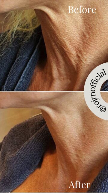 美整オイルでこんなに変わる♥️
詳しくご覧ください🥰
https://rojen.jp/category/before-and-after/
#ROJEN #ロジェン #biseioil #美整オイル #オーガニック
#スキンケア #スキンケアアイテム #美容オイル
#魔法の5秒リフト #塗るサプリメント #エイジングケア
#ゴールデンローズ #美肌 #美BODY #紫外線対策 #紫外線
#シミ対策 #シワ対策 #乾燥肌対策 #免疫力強化
#弾力ある肌に変身